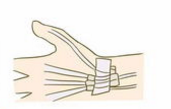 【治疗】手部肌腱损伤的治疗方法